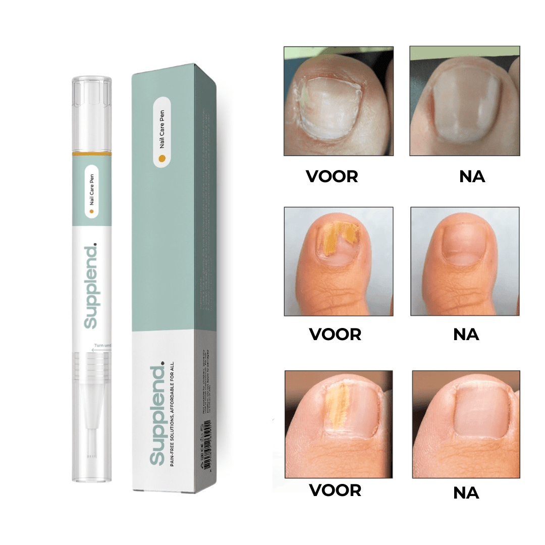 Resultaten voor en na de behandeling van kalknagels met Supplend