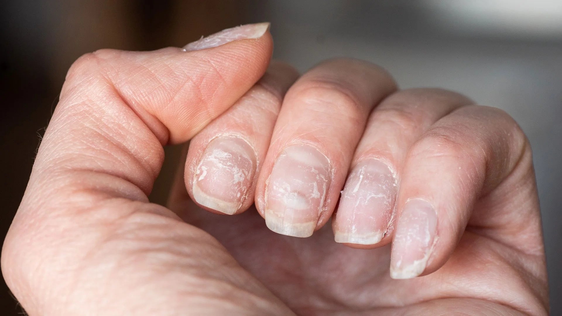 ingernagel met nagelpsoriasis, met zichtbare verkleuring, putjes en verdikking als symptomen van nagelpsoriasis.